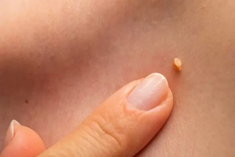 Papilloma op de huid