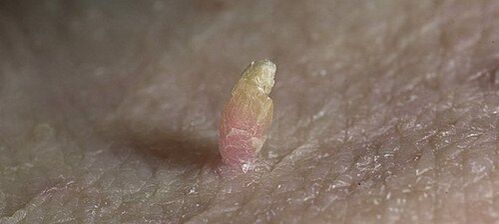papilloma op de penis hoe te verwijderen 