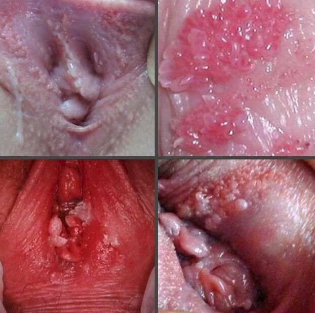 Close-up van papillomen in de vagina