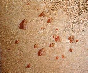 humaan papillomavirus op de huid