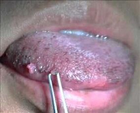 humaan papillomavirus op de tong