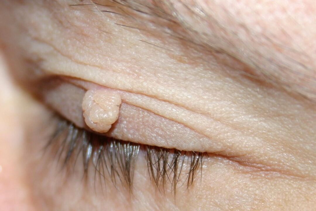symptomen van papilloma op het ooglid