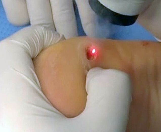 De procedure voor het verwijderen van wratten op de hiel met behulp van een laser