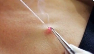 verwijdering van papillomen op het lichaam met een laser
