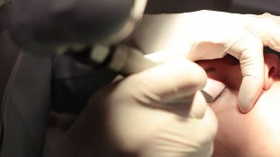 Laserverwijdering van papilloma op het ooglid
